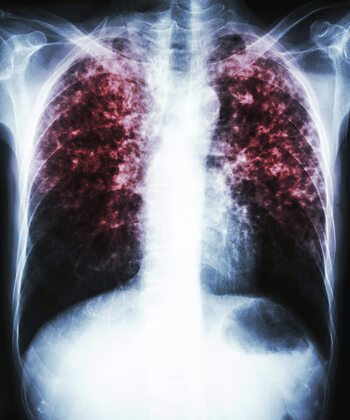 Tuberkulozi nuk është zhdukur. Prof. dr. Silvana Bala: Mos neglizhoni simptomat, këtë vit u diagnostikuan 450 raste të reja 